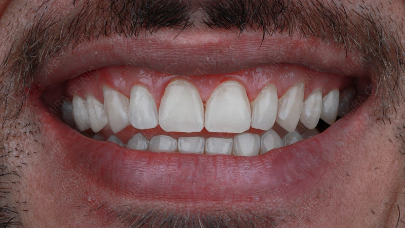 تبييض الأسنان الشاب عوينة